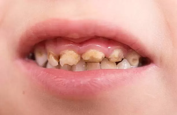 پوسیدگی دندان: یک بیماری عفونی و واگیردار